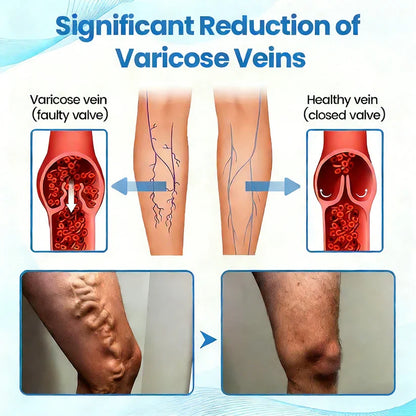 🇨🇦🏆COUGEX® VascuCare Vein Healing Spray(Designed for Varicose veins, Spider veins, Deep vein Thrombosis, Chronic venous insufficiency, Venous ulcers, Thrombophlebitis and other venous issues)