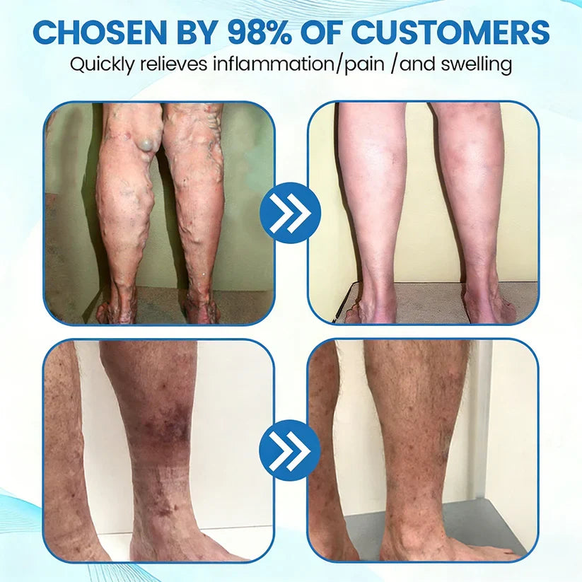 🇨🇦🏆COUGEX® VascuCare Vein Healing Spray(Designed for Varicose veins, Spider veins, Deep vein Thrombosis, Chronic venous insufficiency, Venous ulcers, Thrombophlebitis and other venous issues)