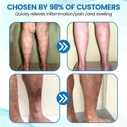 🇨🇦🏆COUGEX® VascuCare Vein Healing Spray(Designed for Varicose veins, Spider veins, Deep vein Thrombosis, Chronic venous insufficiency, Venous ulcers, Thrombophlebitis and other venous issues)