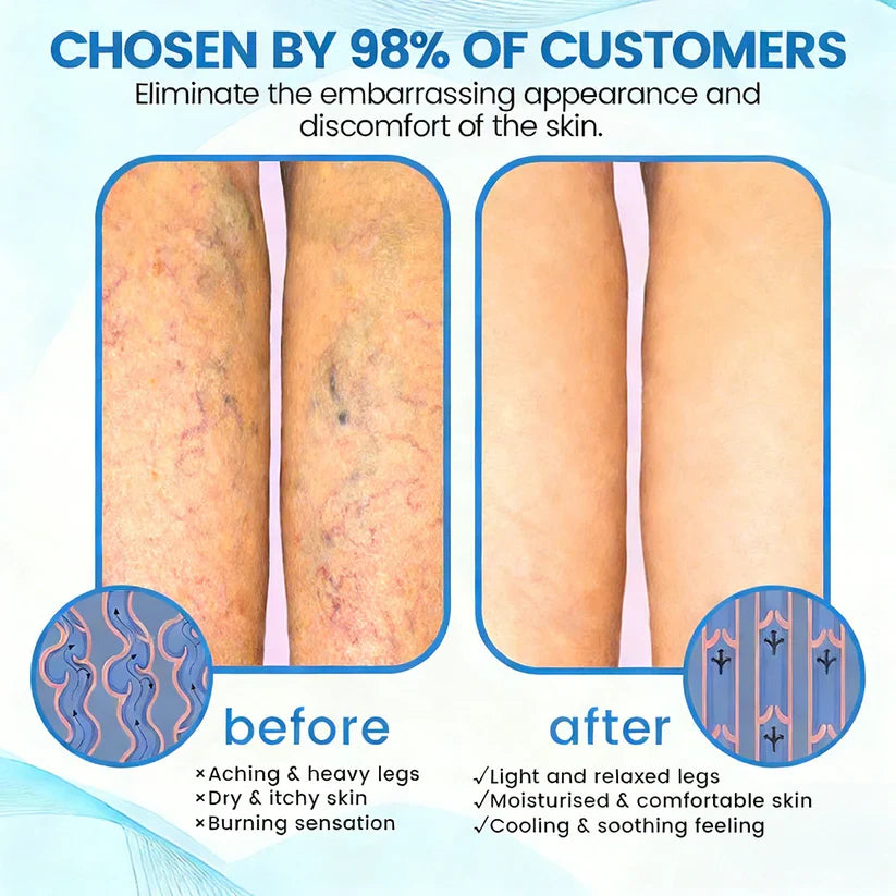 🇨🇦🏆COUGEX® VascuCare Vein Healing Spray(Designed for Varicose veins, Spider veins, Deep vein Thrombosis, Chronic venous insufficiency, Venous ulcers, Thrombophlebitis and other venous issues)