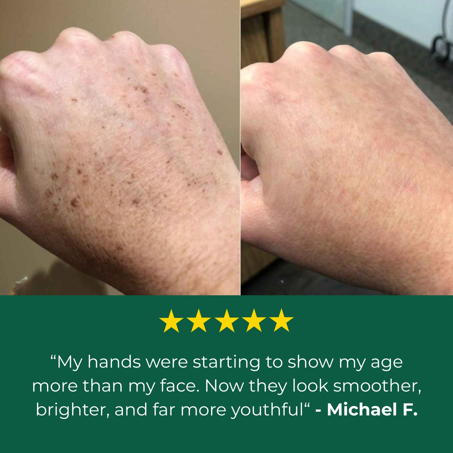 Lovilds Age Spot Cream