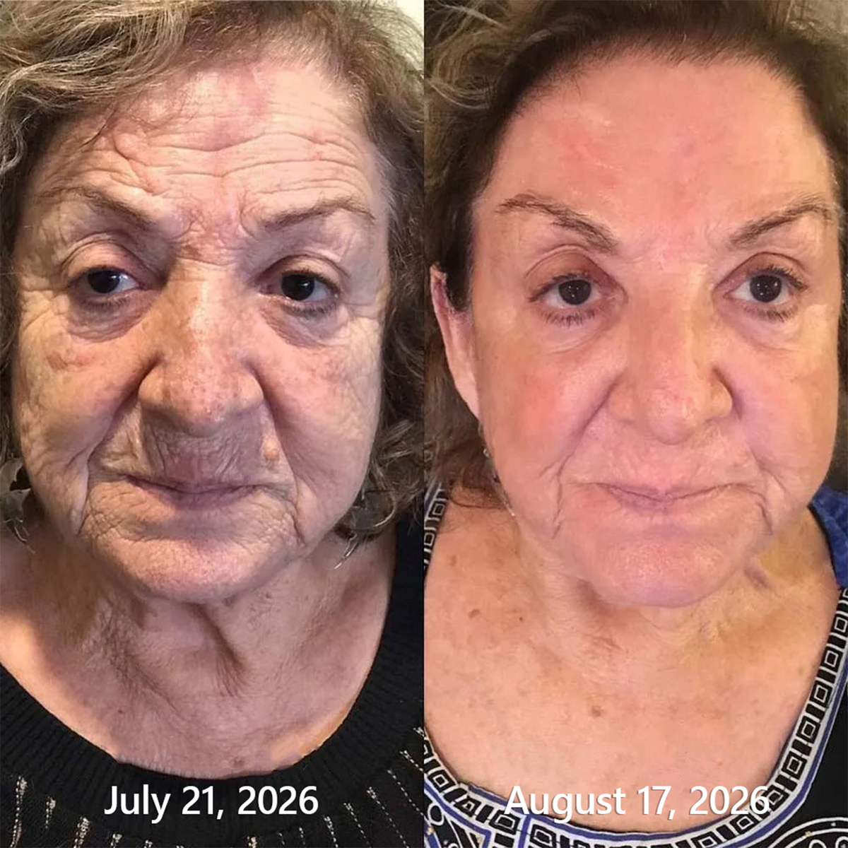 Alisanda® 💃💃𝑷𝑫𝑹𝑵 𝑨𝒏𝒕𝒊-𝑨𝒈𝒊𝒏𝒈 & 𝑻𝒂𝒓𝒈𝒆𝒕𝒆𝒅 𝑺𝒑𝒐𝒕 𝑹𝒆𝒏𝒆𝒘𝒂𝒍 𝑺𝒕𝒊𝒄𝒌（𝑯𝒆𝒍𝒑𝒔 𝑺𝒎𝒐𝒐𝒕𝒉 𝑾𝒓𝒊𝒏𝒌𝒍𝒆𝒔, 𝑺𝒖𝒑𝒑𝒐𝒓𝒕 𝑭𝒊𝒓𝒎𝒆𝒓-𝑳𝒐𝒐𝒌𝒊𝒏𝒈 𝑺𝒌𝒊𝒏, 𝒂𝒏𝒅 𝑰𝒎𝒑𝒓𝒐𝒗𝒆 𝑻𝒉𝒆 𝑨𝒑𝒑𝒆𝒂𝒓𝒂𝒏𝒄𝒆 𝑶𝒇 𝑽𝒊𝒔𝒊𝒃𝒍𝒆 𝑺𝒑𝒐𝒕𝒔）
