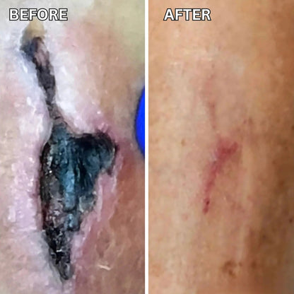 Shield Fragile Diabetic Feet in as Little as 60 Seconds