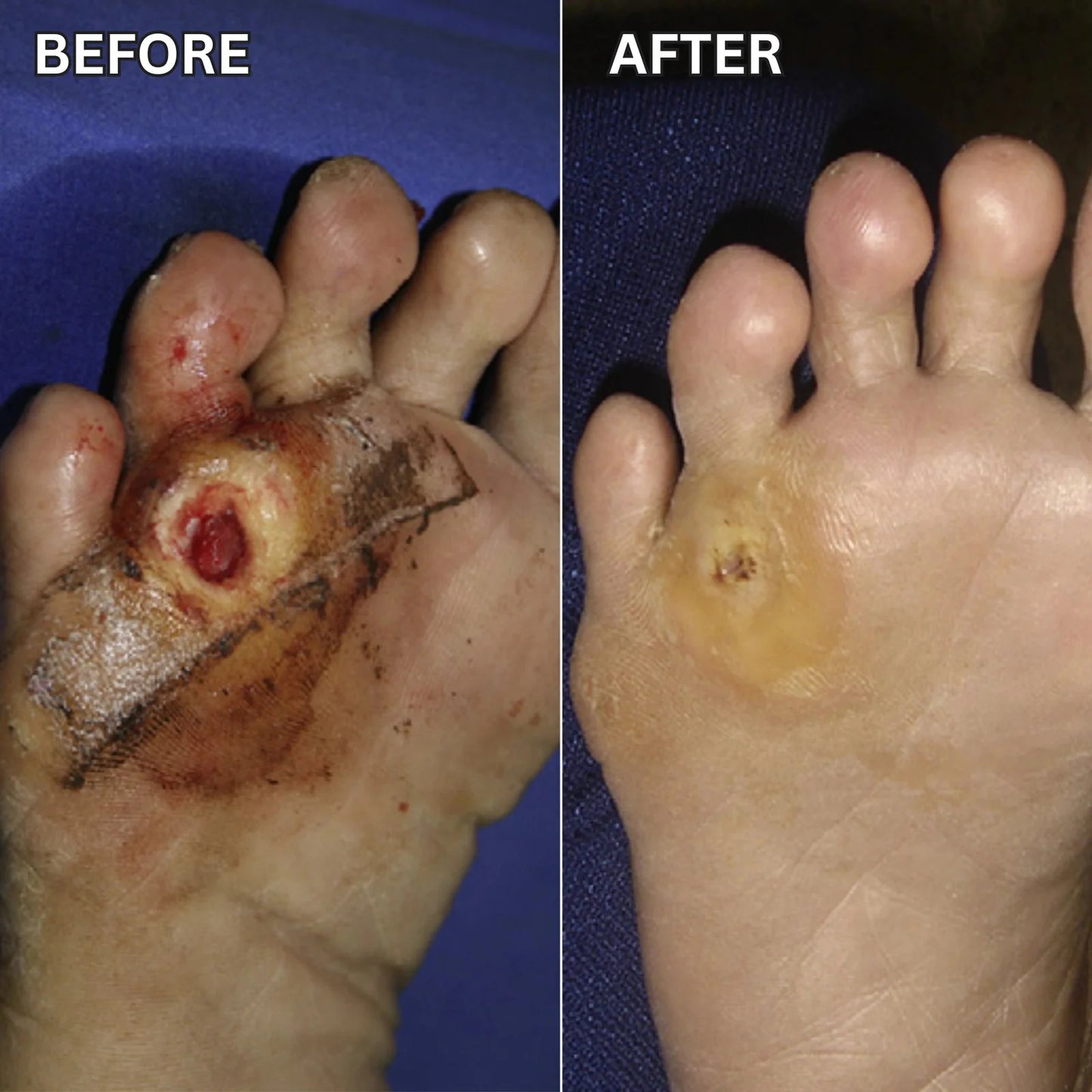 Shield Fragile Diabetic Feet in as Little as 60 Seconds