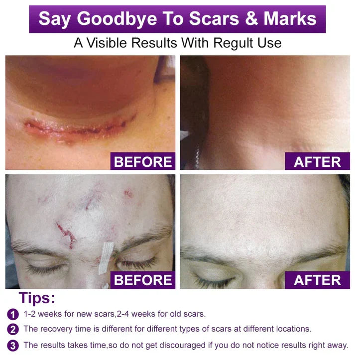 Advanced Scar Gel – Treats old and new scars, helps reduce the appearance of scars from acne, surgery, burns, injuries, and stretch marks