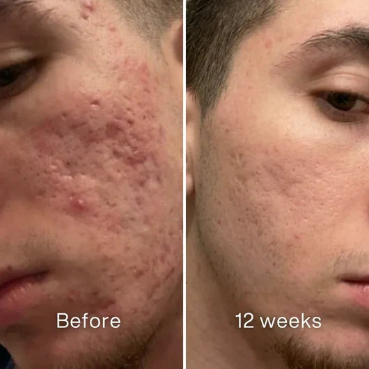 Jaxvolt™Clinical Acne Scar Remodeling Stick