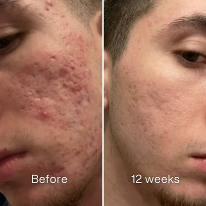 Jaxvolt™Clinical Acne Scar Remodeling Stick