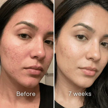 Jaxvolt™Clinical Acne Scar Remodeling Stick