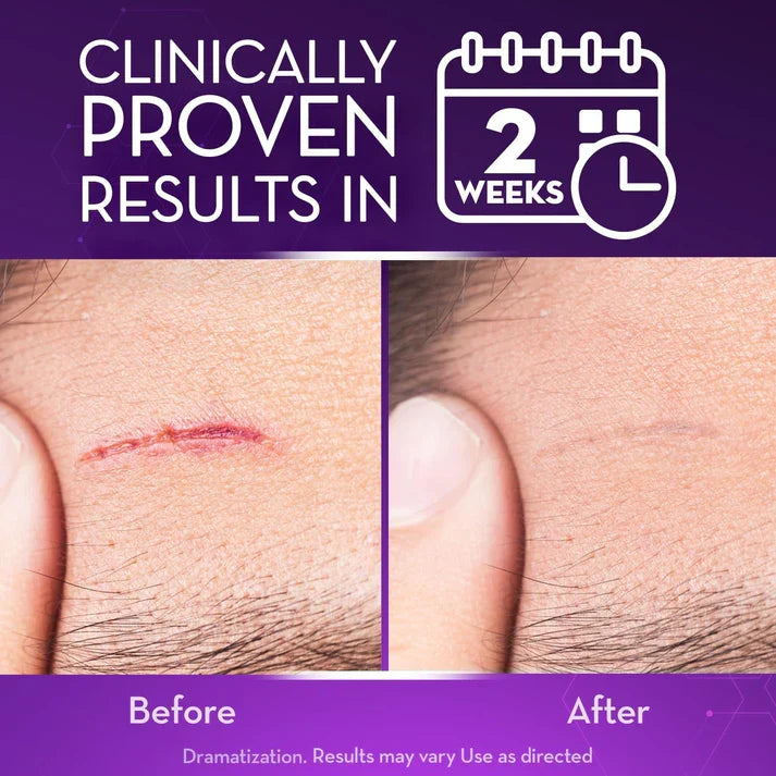 Advanced Scar Gel – Treats old and new scars, helps reduce the appearance of scars from acne, surgery, burns, injuries, and stretch marks