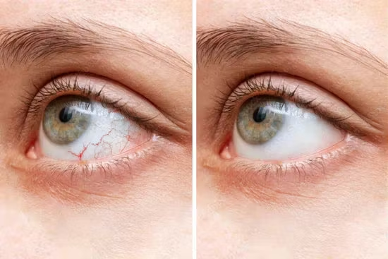 Eye redness before and after customer story
